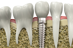 博多区比恵町・
                        スノーデンタルオフィス・インプラント