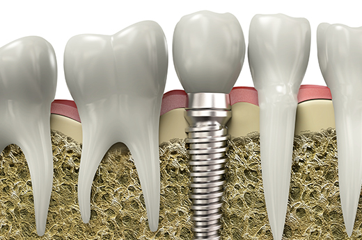博多区比恵町・スノーデンタルオフィス・インプラント